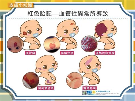 胸前有胎記|認識胎記的種類與治療照顧